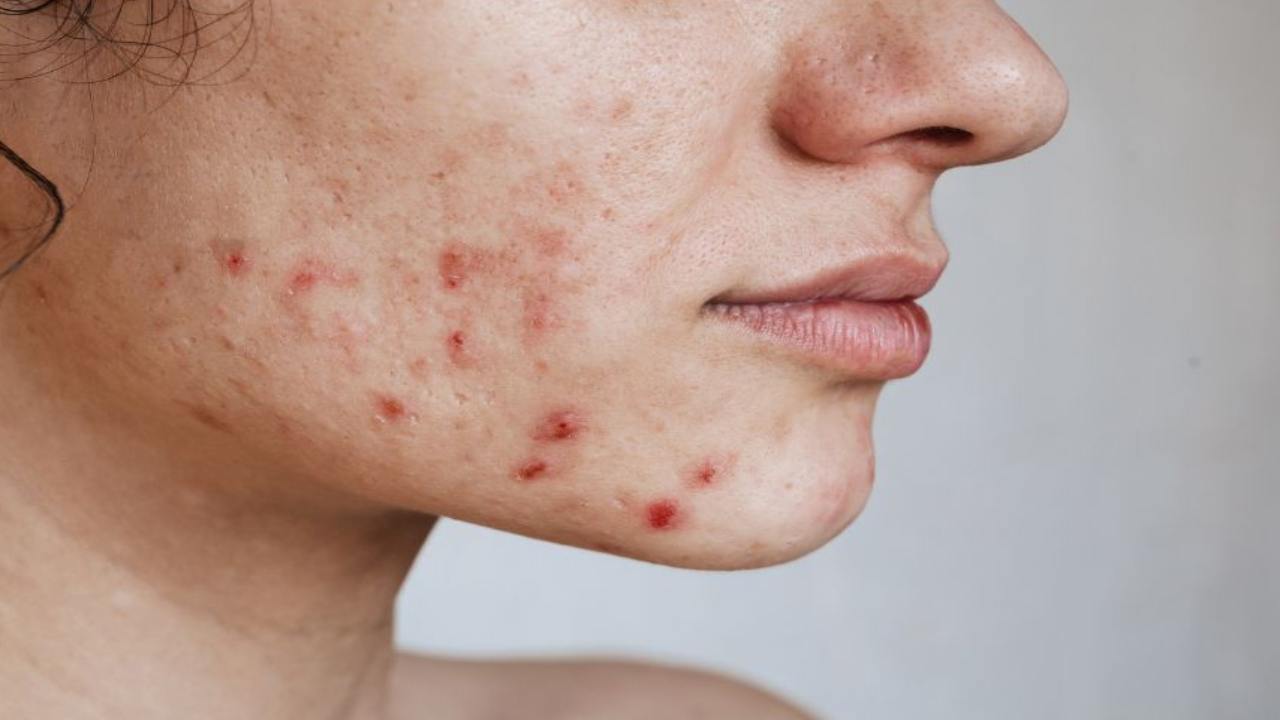 Acne viso